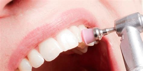 profilaxia dental